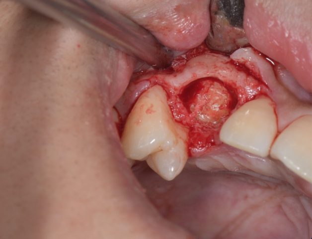 歯牙腫　術中